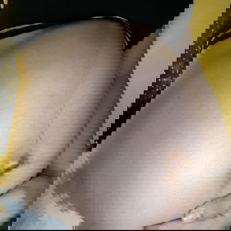 ขอแชร์ประสบการณ์ท้องไม่แตกลาย