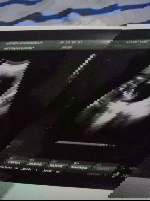 HASIL USG BISA SALAH PREDIKSI GK YA?