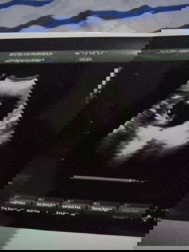 HASIL USG BISA SALAH PREDIKSI GK YA?