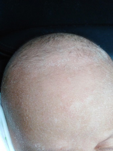 Kulit bayi kering