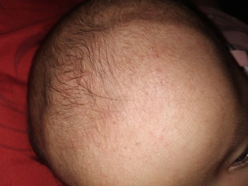 Obat biang keringat apa ya bun