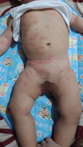 mga mommies, ask ko lang po ano kaya tong pantal sa baby ko cetaphil user sya since new born.