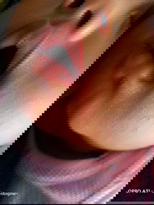 Cari solusi menghilangkan merah-merah bekas susu dan biang kringat dong bun ,,