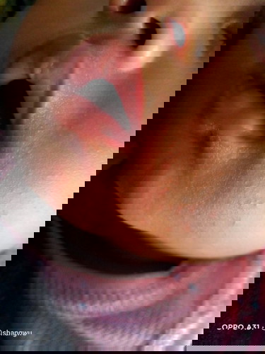 Cari solusi menghilangkan merah-merah bekas susu dan biang kringat dong bun ,,