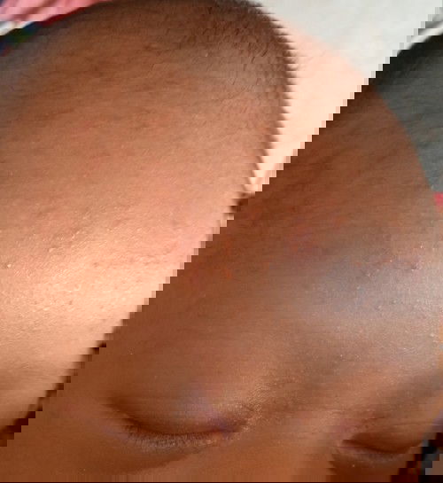 Kulit newborn Bruntusan