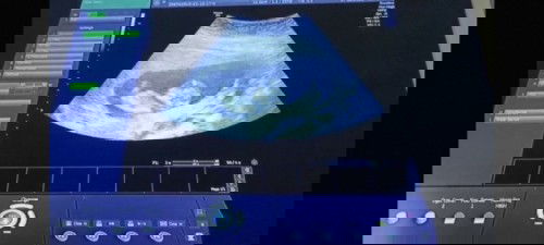 Hamil 11w 5day ada kista kiri & kanan sebesar 5cm lbh