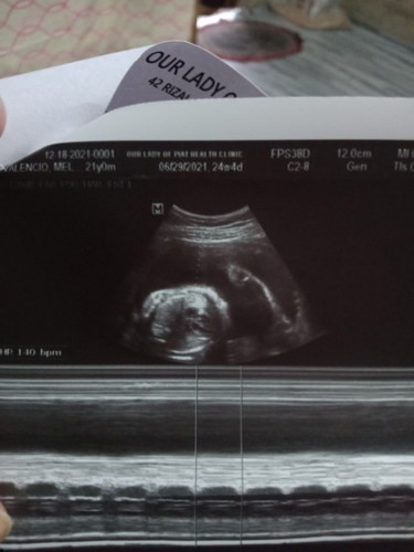 #Firstime .. mga mommy 24 weeks pregnant baby girl sabi ng OB ko ganito din po ba sa inyo mga mommy