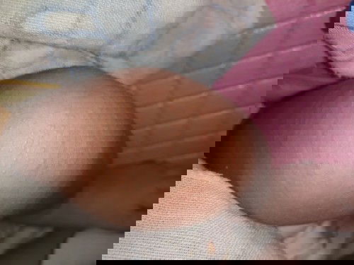 Bintik pada anak 2 bulan