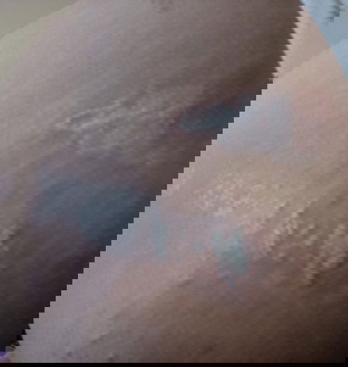 Ruam perih pas hamil rasanya kayak kebakar kena cabai