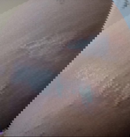 Ruam perih pas hamil rasanya kayak kebakar kena cabai