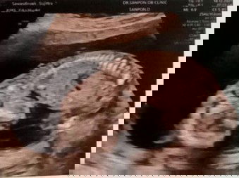 นัดตรวจดาวน์ซินโดรม