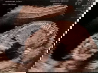 นัดตรวจดาวน์ซินโดรม