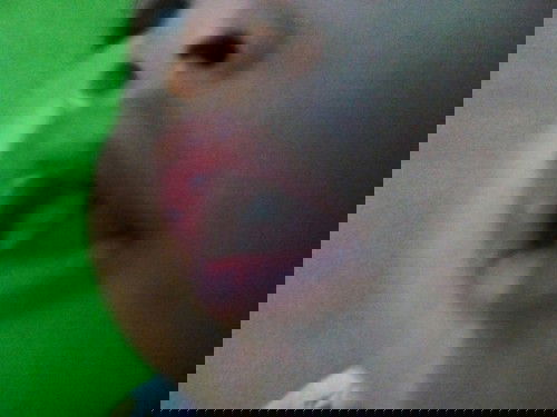 sariawan bayi 5bulan