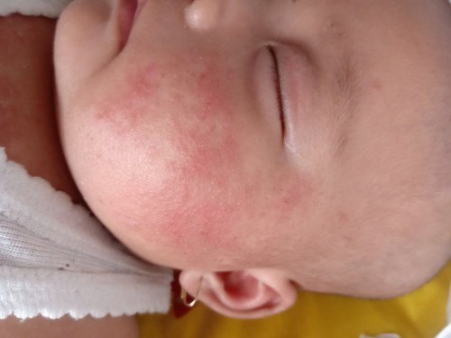 bayi ruam