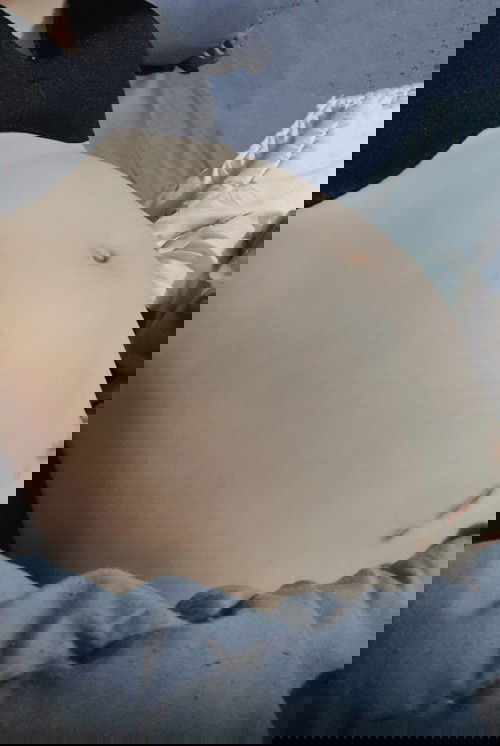 ท้องแรกกับแผลที่เคยผ่าตัด