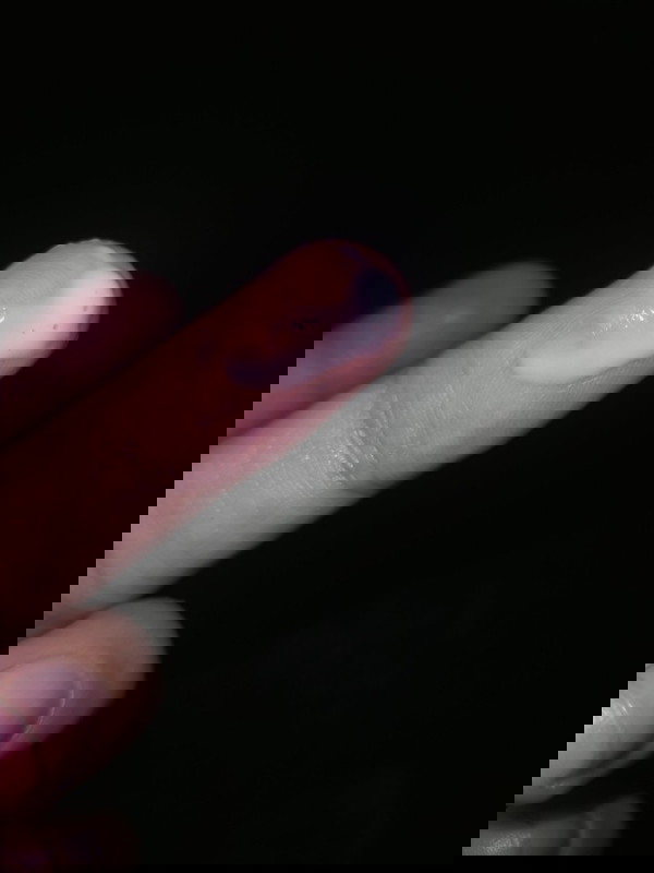 White milky discharge Normal lang po ba may lumabas na ganit