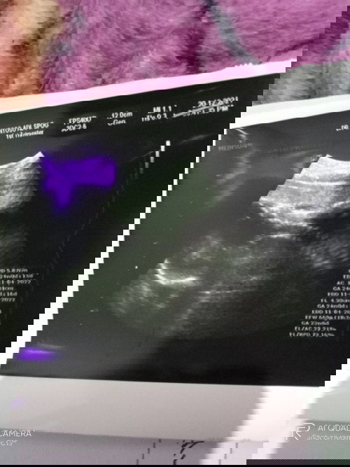 Bayi sungsang dan terlilit tali pusar