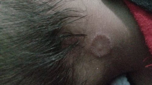 Ruam atau gigitan serangga ya ?