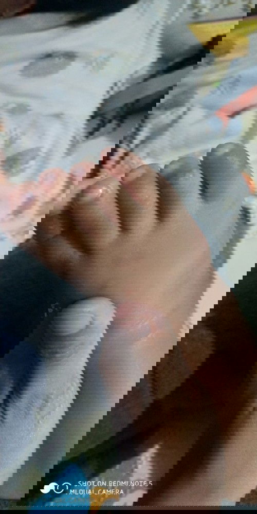 Bentol berair pada bayi
Ada yang pernah nagalamin bun?