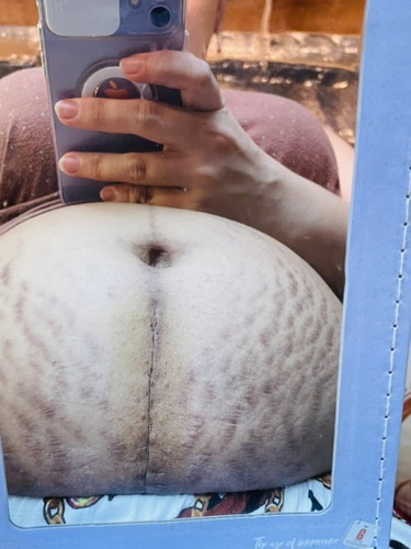 CS scar. 11 days PP. Hi mommies patuyo na po kaya etong tahi ko?