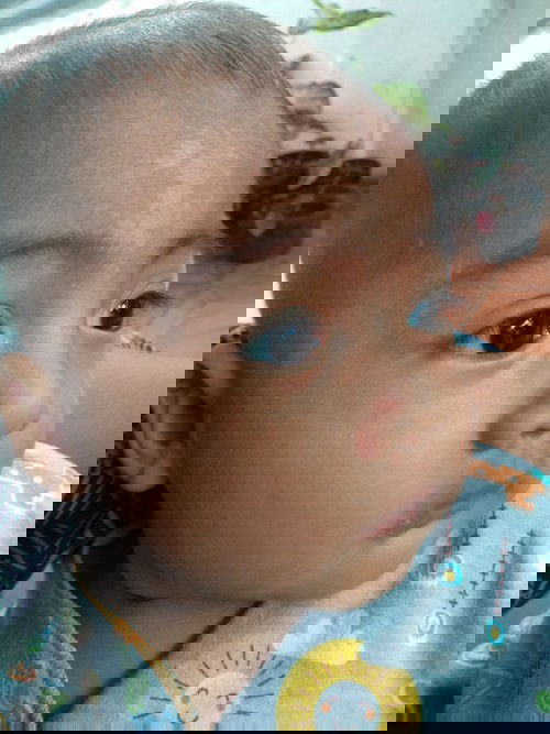 BERCAK PUTIH DI DAHI BABY