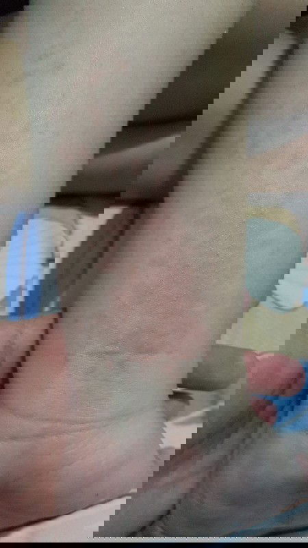 Bintik² merah dan gatal