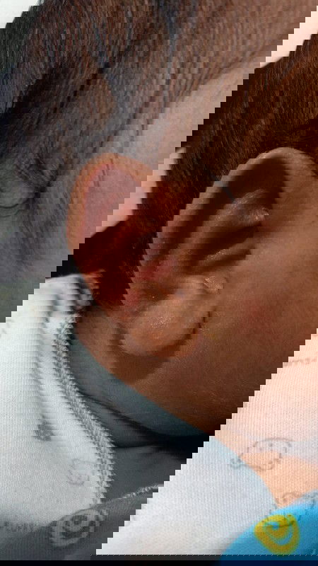 Daun telinga mengeluarkan cairan kuning