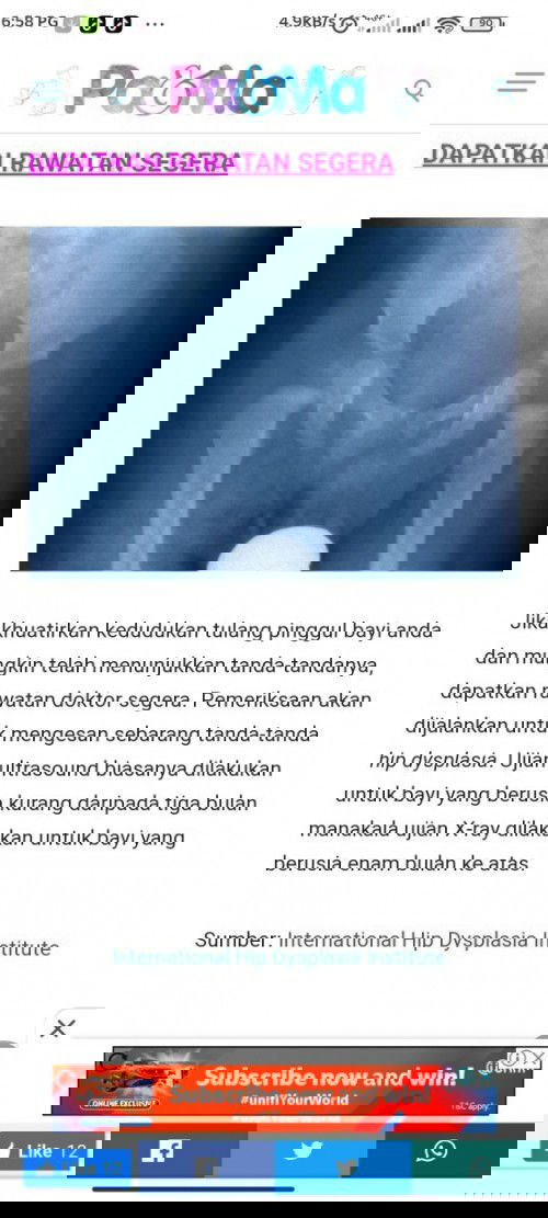 Tulang pinggul bayi xnampak bila xtray