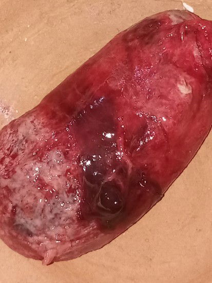 Keguguran di minggu 14week