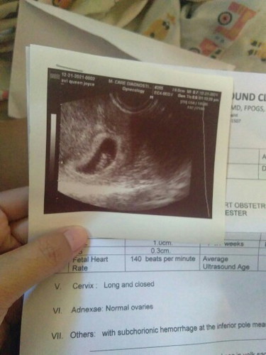 Subchorionic hemorrhage