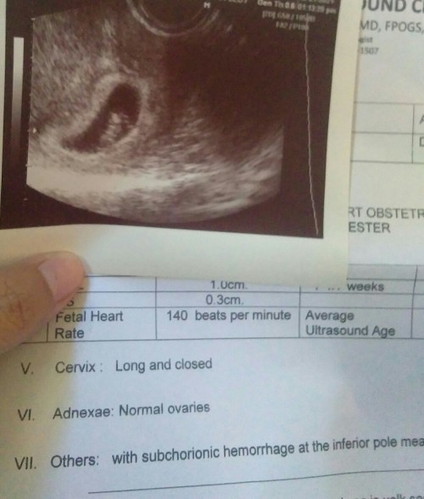 Subchorionic hemorrhage
