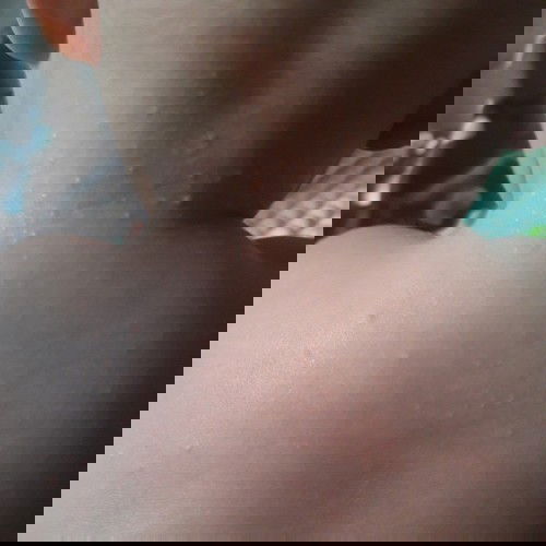 Bintik bintik pada leher bayi