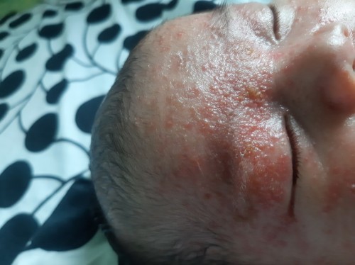 Baby Rashes