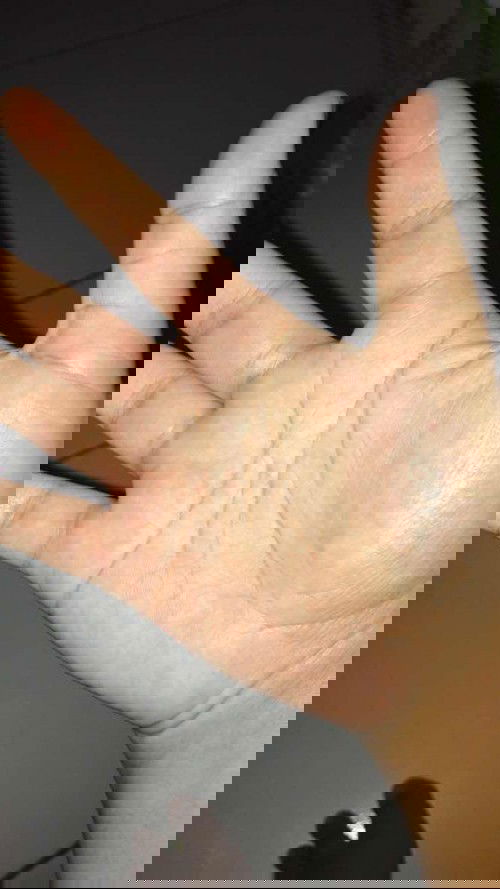 Telapak tangan gatal dan merah