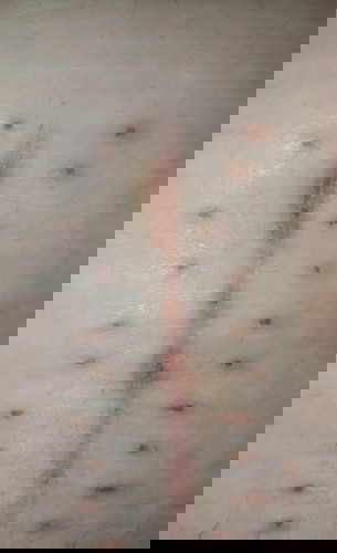 ผ่าท้อง ท้องนอกมดลูก