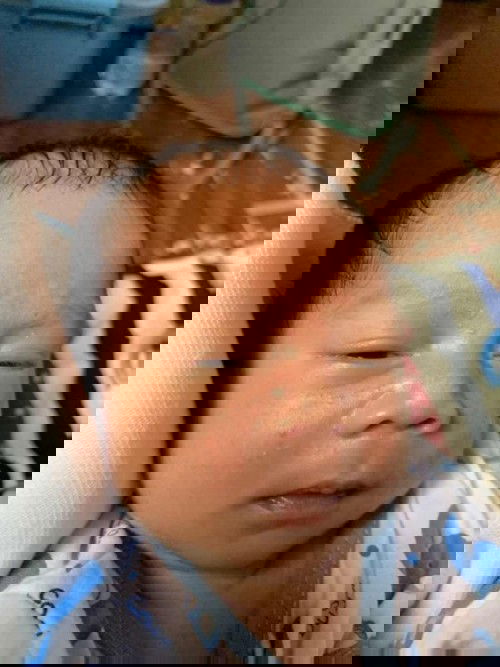 Baby Acne/Normal ba eto sa Newborn?