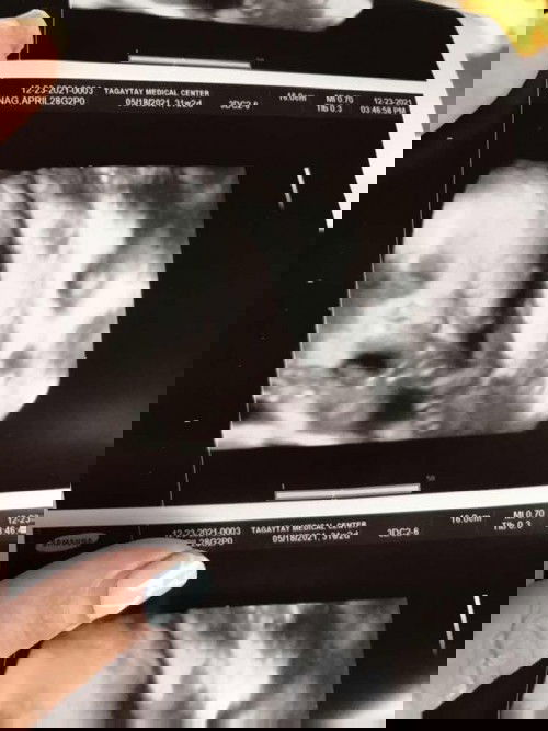 Cephalic Anterior II