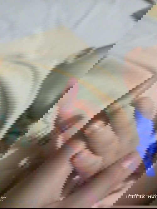 Jari tangan nya gembung merah dan bernanah