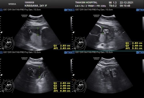หมอบอกน้ำคล้ำค่อนข้างน้อย บ้านนี้กังวลมากเลยคะ ท้อง27วีคคะ อันตรายมากไหมคะ