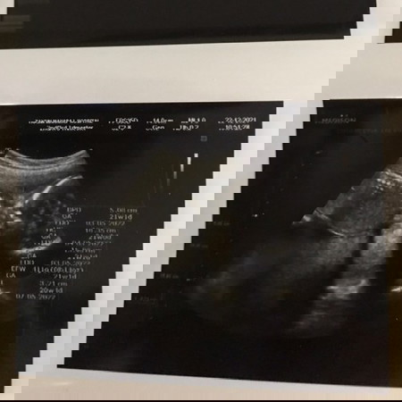 แม่ๆคนไหนดูออกมั้ยคะ หญิง หรือ ชาย อัลตราซาวด์ตอน21W ทีมเมษา 65ค่ะ