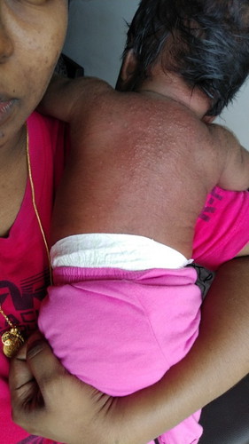 Enzymes and Cradle Cap