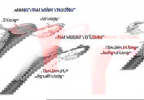 Chia sẻ dấu hiệu thai ngoài tử cung tự tiêu