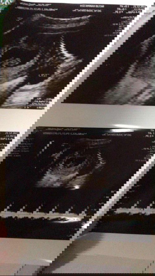 Bun mau nanya tentang kista di awal kehamilan