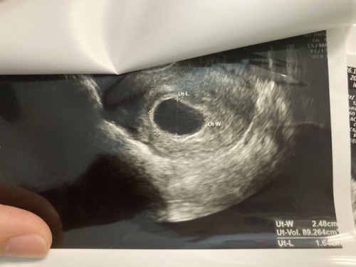 มีโอกาสมีน้อง หรือ ท้องลมคะ?