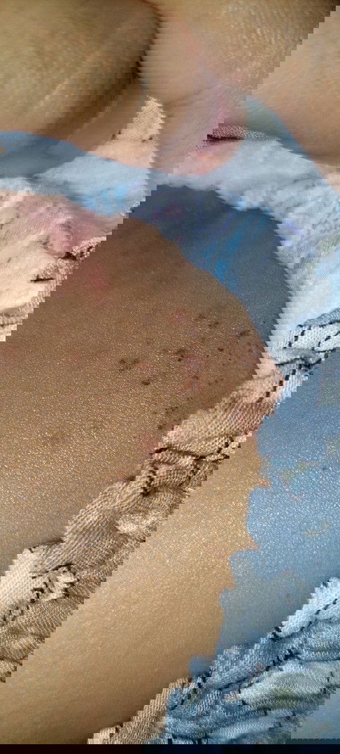 Hai bund, mau tau dong rekomendasi obat ruam/biang keringat yg ampuh.