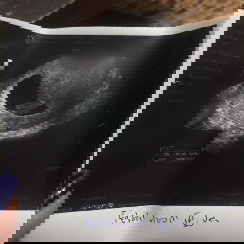 8week แม่แพ้ท้องหนักมาก อัตราซาวทางช่องคลอด