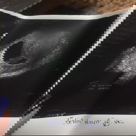 8week แม่แพ้ท้องหนักมาก อัตราซาวทางช่องคลอด