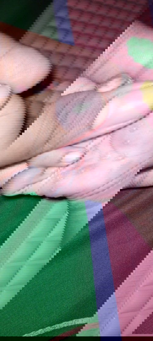 Bintik berair dan bernanah pada bayi