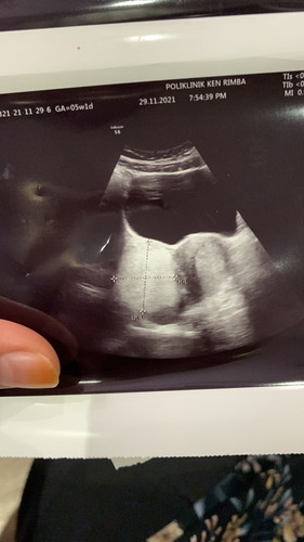8 minggu with cyst/fibroid