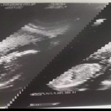 #ตั้งได้ครรถ์38Week5วัน มีอาการปวดหน่วงๆท้องน้อย กำหนดคลอด วันที่2มกราคม2565